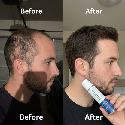 LOVILDS Hair Growth Roll on Serum